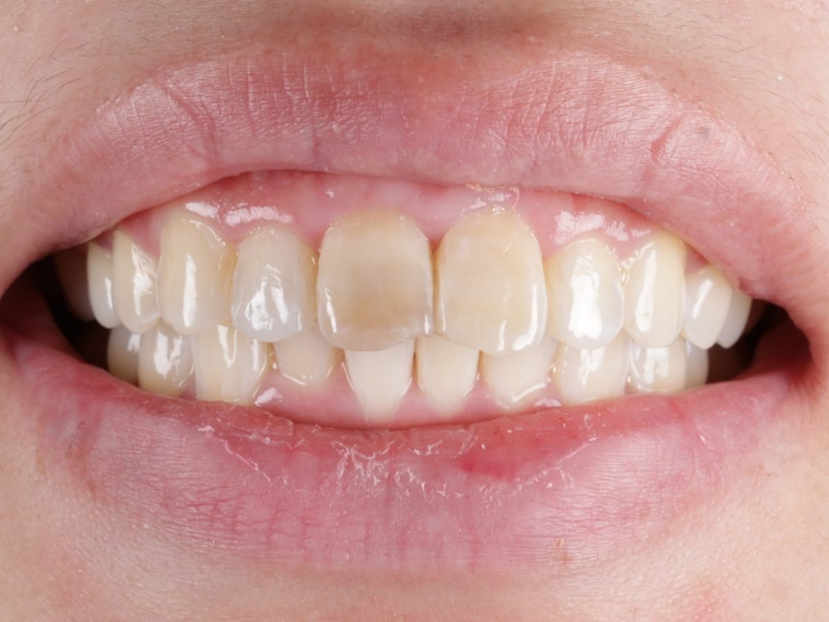 before treatment, case 3