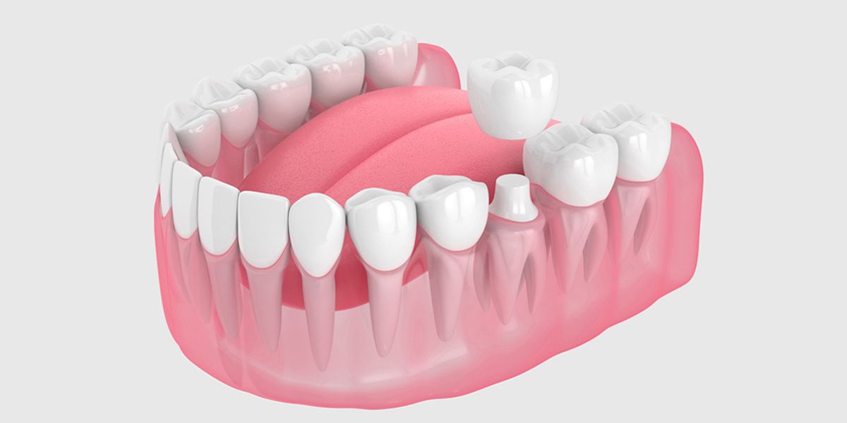 Dental Crown vs Dental Onlays: Everything you Need to know.