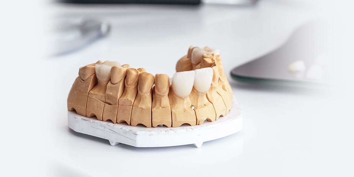 Discover everything about dental veneers in our comprehensive blog. Learn about types, benefits, and procedures. Get the smile you've always wanted!