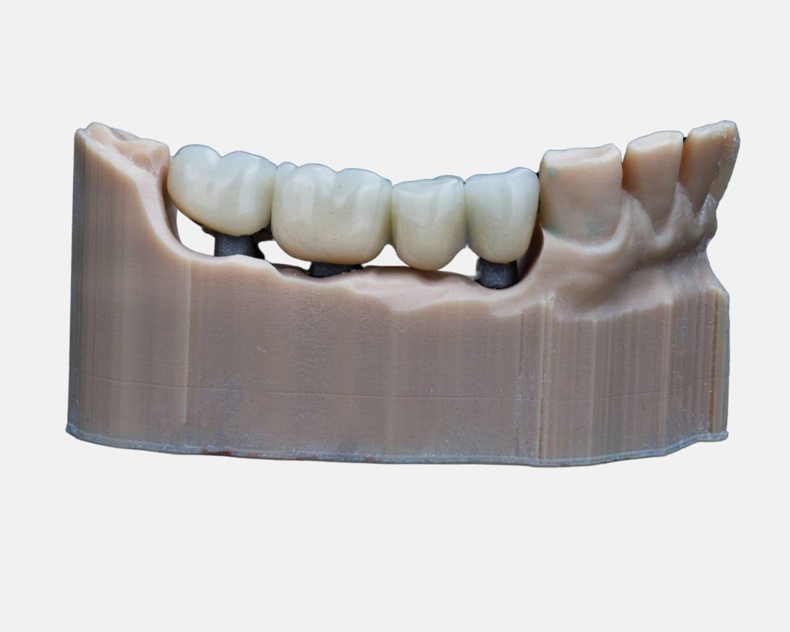 Dental Bridges and Crowns