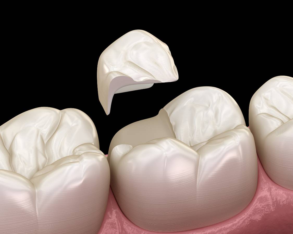 Dental Inlays and Onlays