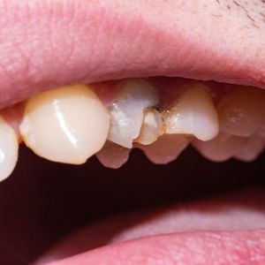 Chipped, Cracked, or Broken Teeth