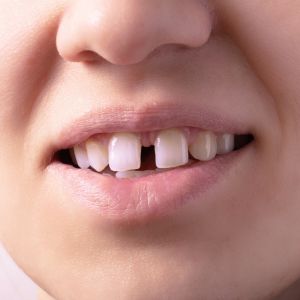 Gaps Between Teeth