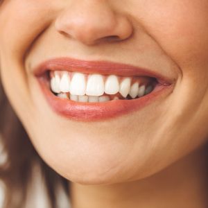 Complete Smile Makeover
